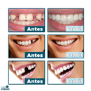 (Compre 1 Leve 2) Lente Dental Ajustável - Inferior e Superior | BRINDE CAPINHA PROTETORA + FRETE GRÁTIS!